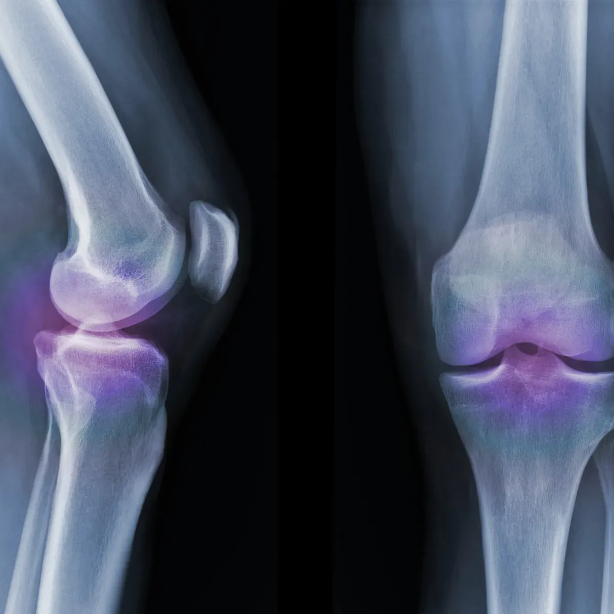 Two X-ray images of a human knee with color markings
